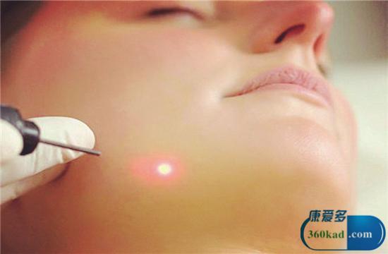 激光祛疤真的有效吗,烧伤激光祛疤的最佳时间