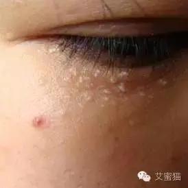 脸上每一个毛孔都是油脂粒,脸上老是长油脂粒怎么回事