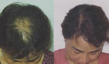 掉头发比较厉害怎么办,掉头发很厉害怎么解决