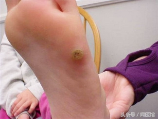 跖疣和湿疣是一种病毒吗,跖疣应与足部的鸡眼和瘊子鉴别