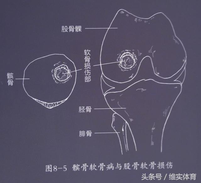 高尔夫手病,高尔夫球肘的发病率