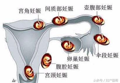 异位妊娠的解释,异位妊娠最常见部位