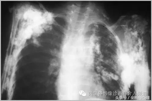 软组织钙化与骨化,软组织钙化和骨质增生