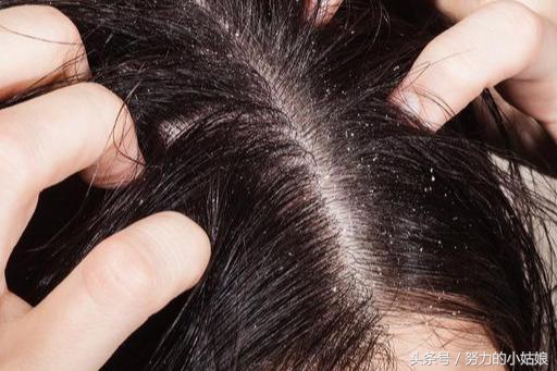 头上为什么会有螨虫？阿婆用一勺盐祛螨，千万螨虫落荒而逃