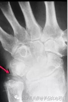 软组织钙化与骨化,软组织钙化和骨质增生