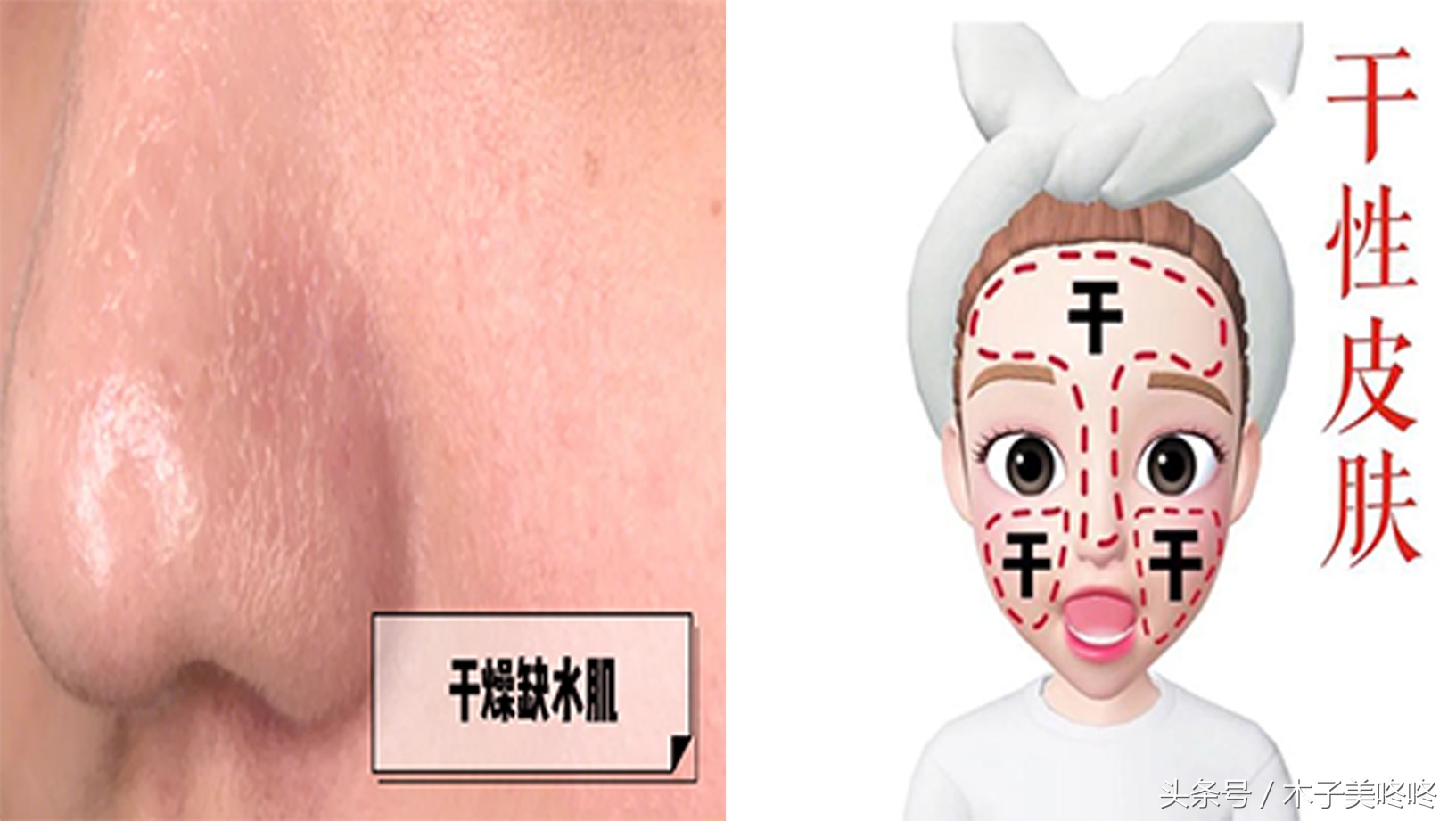 爽肤水刺痛是过敏还是干,涂爽肤水刺痛是缺水吗