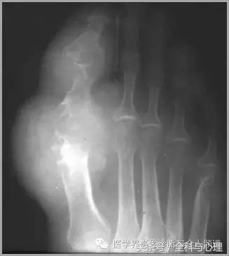 软组织钙化与骨化,软组织钙化和骨质增生