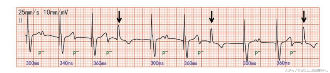 继发性stt异常是什么意思,心电图继发性st-t改变是什么意思