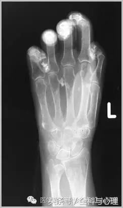 软组织钙化与骨化,软组织钙化和骨质增生