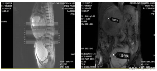 婆婆腹中长足球大的瘤！还两个！看医生们“拆弹”