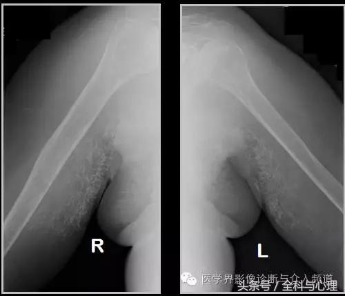 软组织钙化与骨化,软组织钙化和骨质增生