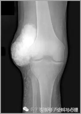 软组织钙化与骨化,软组织钙化和骨质增生