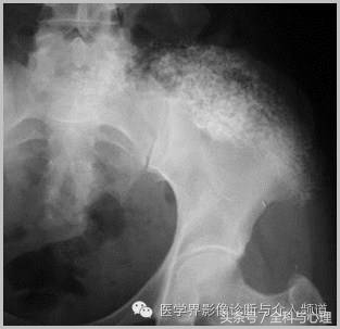 软组织钙化与骨化,软组织钙化和骨质增生