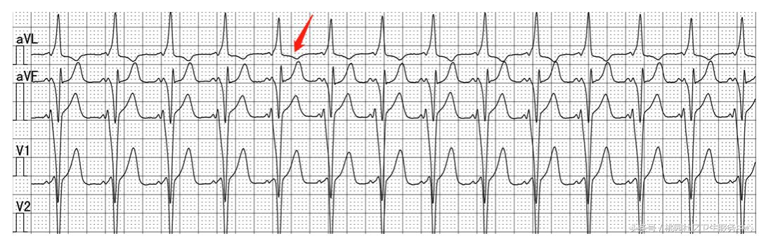 继发性stt异常是什么意思,心电图继发性st-t改变是什么意思
