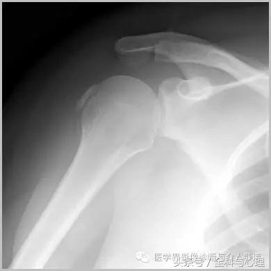 软组织钙化与骨化,软组织钙化和骨质增生