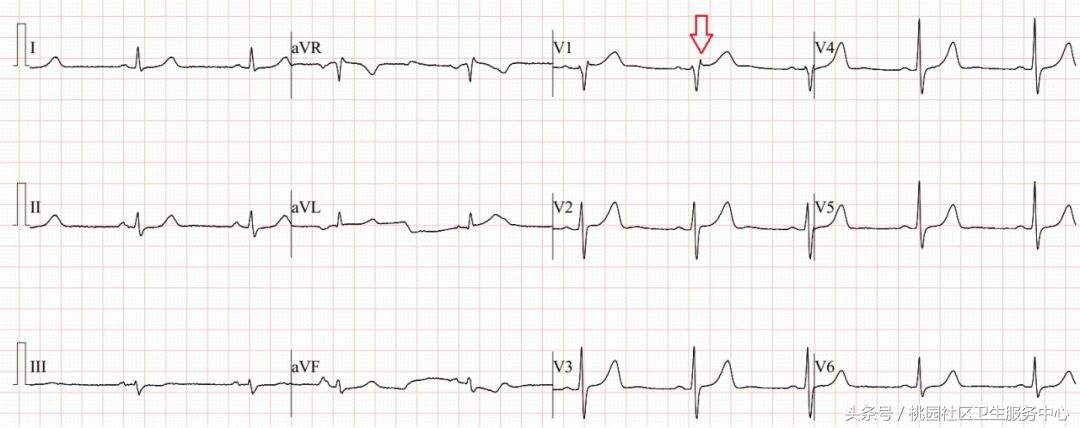 继发性stt异常是什么意思,心电图继发性st-t改变是什么意思