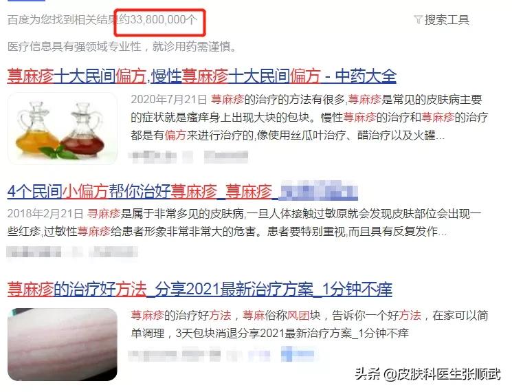 荨麻疹针刺消除的最佳方法,民间治疗荨麻疹最好的方法