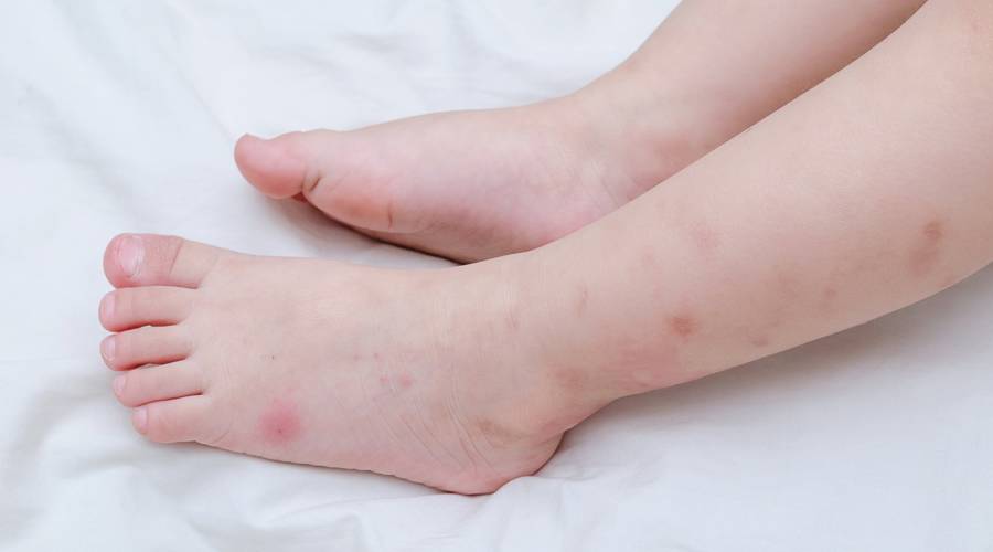 宝宝身上有小疙瘩怎么消除,宝宝身上小疙瘩图片