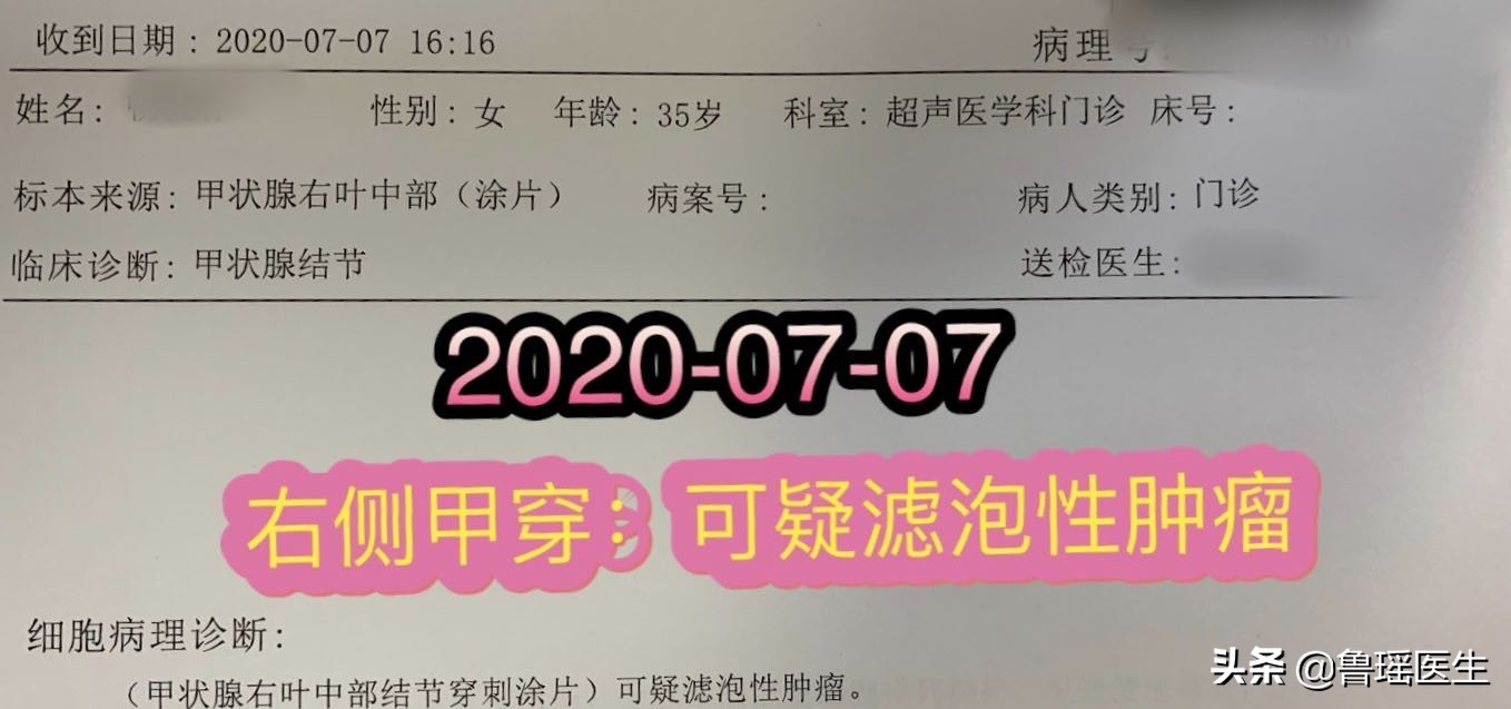 做b超一定能发现甲状腺结节吗,多次b超对结节有刺激吗