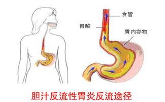 胆囊把胆汁输送到哪里,胆囊炎和胃病胆汁反流有区别吗