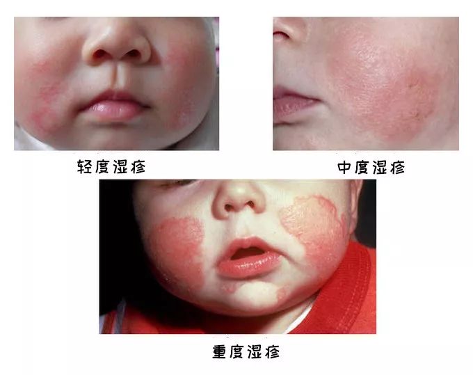 小孩湿疹老是不好怎么办,孩子湿疹怎么办最有效的方法