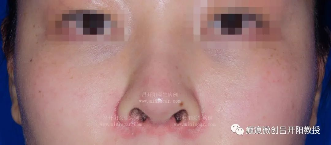强脉冲激光治疗脸部视频,点阵激光嫩肤