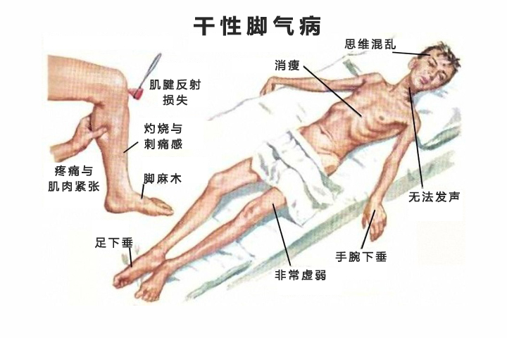 维生素b1缺乏症为啥叫脚气病,维生素B1缺乏引起的脚气病