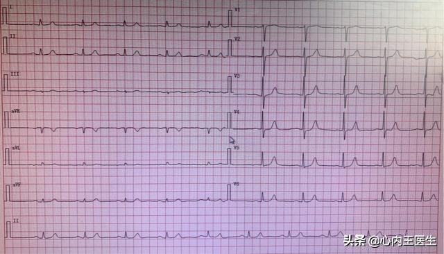 心慌发作怎么急救,反复心慌气短怎么回事
