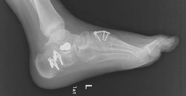 中年人扁平足做微创手术,僵硬型扁平足手术