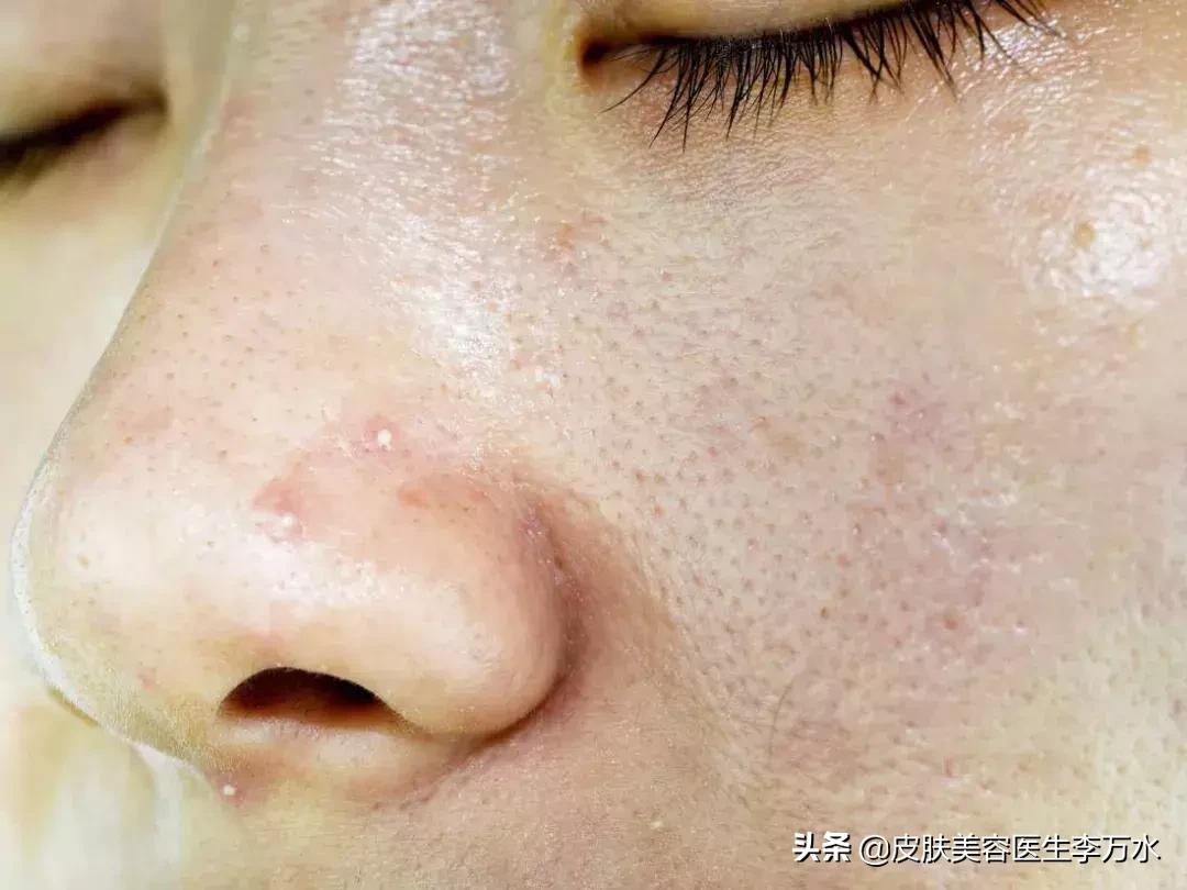 大油皮的坏处是什么,大油皮为啥还起皮