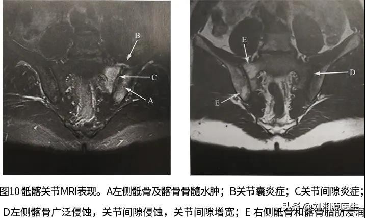 怀孕如何避免强直性脊柱炎,免疫修复治强直性脊柱炎