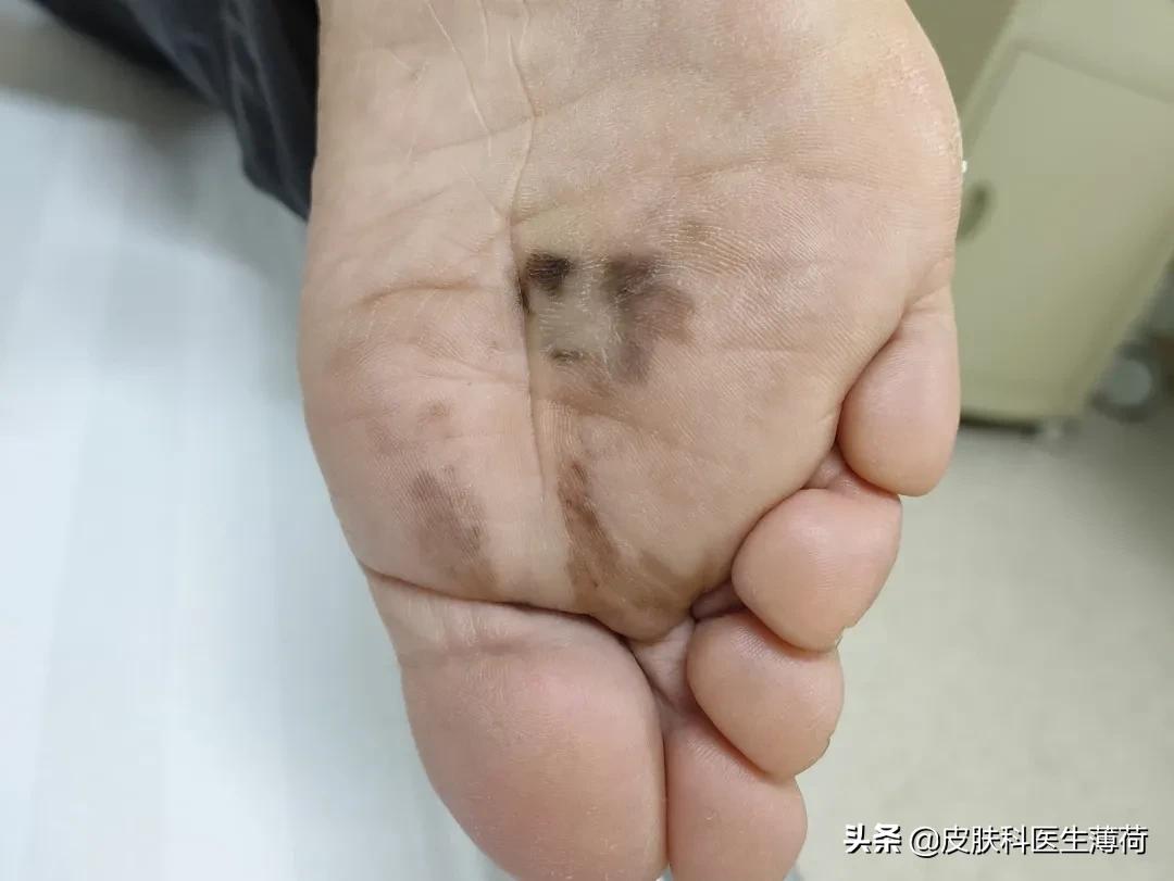 这颗痣，“点”完可能会要命