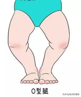 o型腿宝宝x型腿怎么判断,怎么判断孩子的腿是不是o型腿