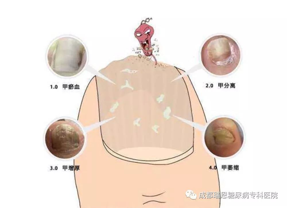 预防糖尿病并发症的药有哪些,糖尿病患者发生血汗管疾病的危险