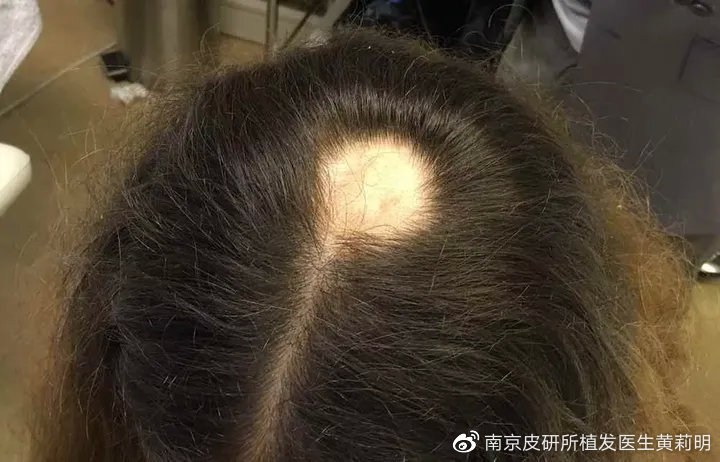 我的头顶感觉凹了怎么回事,我的头顶为什么有点凹陷