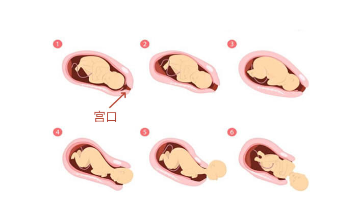 宫口开十指后如何超快顺产,开十指顺产多长时间