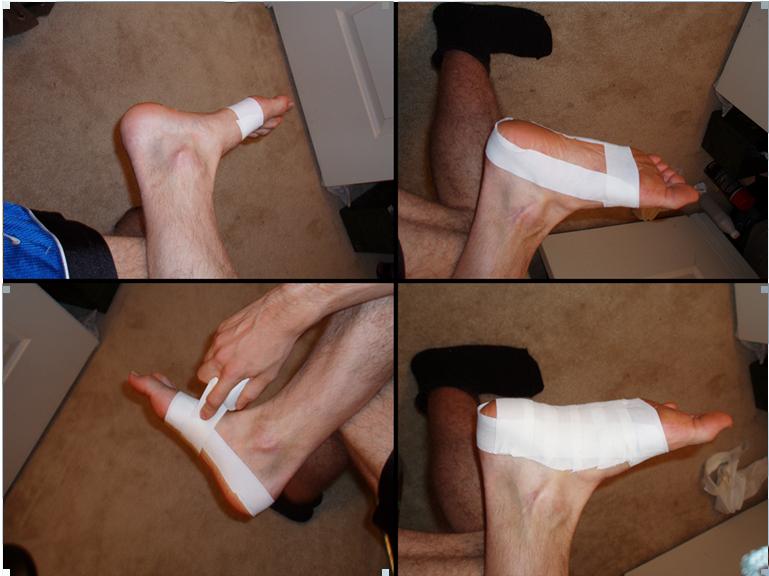 跳绳能改善足底筋膜炎吗,足底筋膜炎做深蹲可以改善吗