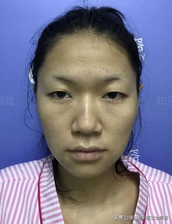 鼻子变挺的方法,想要鼻子变挺去哪里好