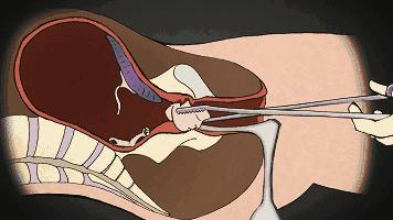 男用避孕药通过试验，网友：叫刘阳打针，半藏森林你不用吃药了