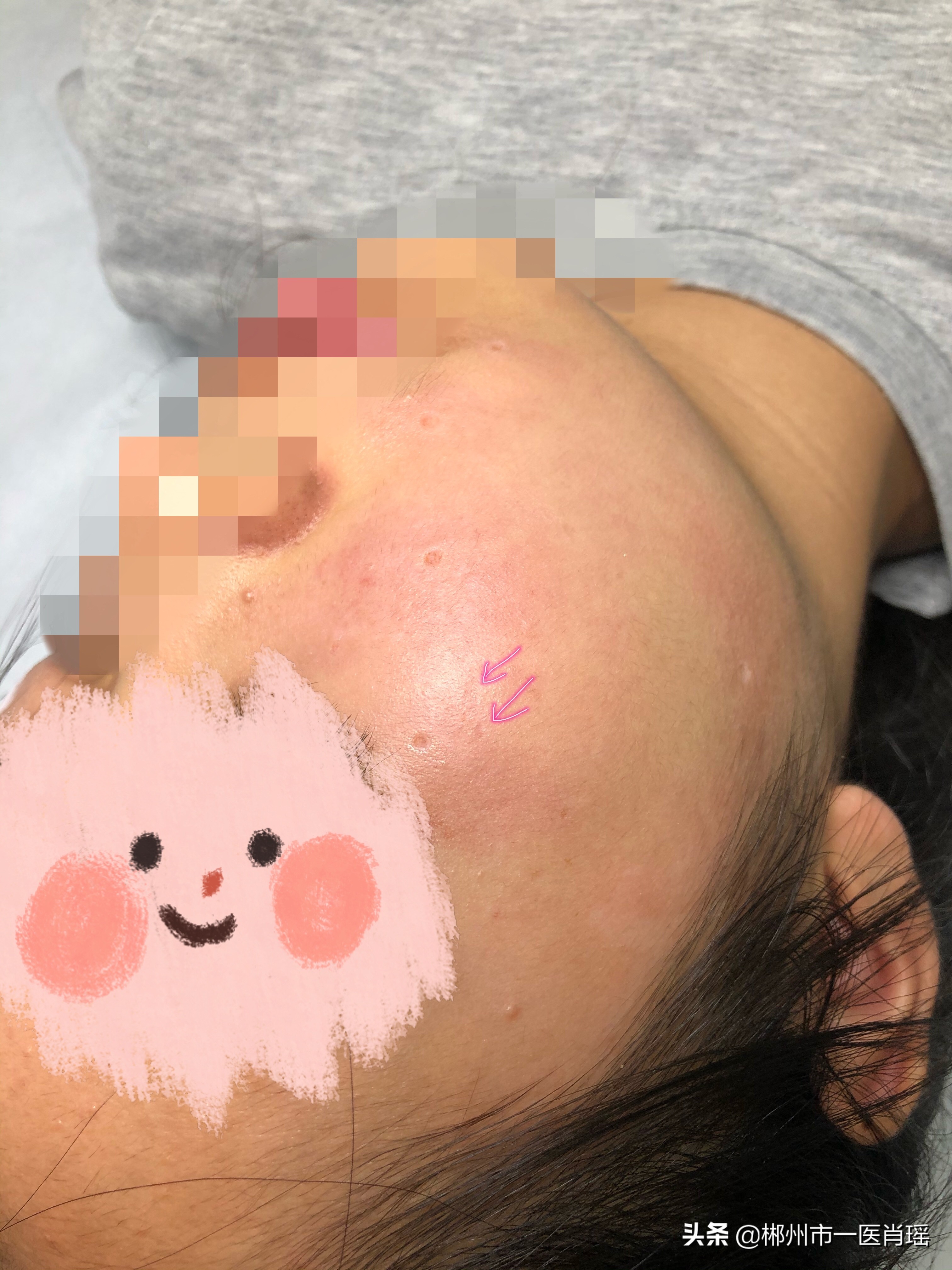 激光点痣留下的凹坑怎么修复,激光点痣会留疤有凹陷吗会好吗