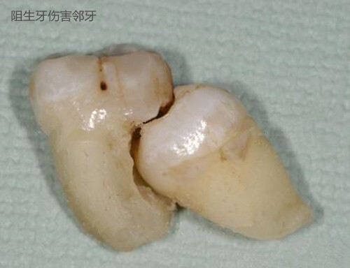 拔智齿断的一点在里面没有关系吗,拔智齿断了牙根留在里面如何处理