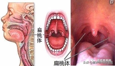 扁桃体炎经过抗炎治疗几天能好,扁桃体发炎中医辨证治疗