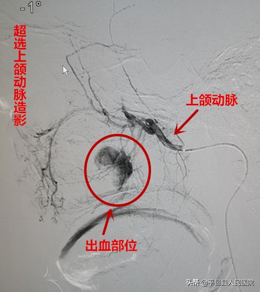 鼻出血止血的方法有血管栓塞法吗,介入治疗鼻出血是怎么操作