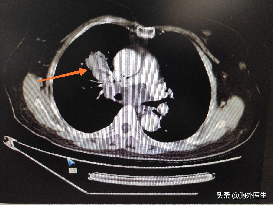 得了癌症，手术、放化疗、靶向、免疫治疗该怎么选？