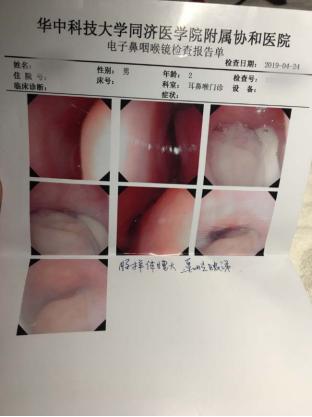 咳嗽引起的湿疹有什么影响,张嘴呼吸咳嗽