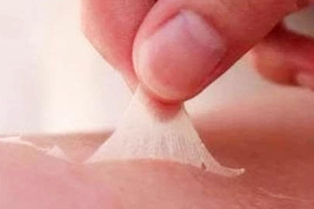 为什么剖腹产伤口会疤痕增生,剖腹产伤口疤痕变化