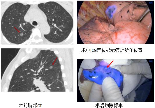 全球对肺癌治疗的最有效最新技术,肺癌的支气管镜介入治疗