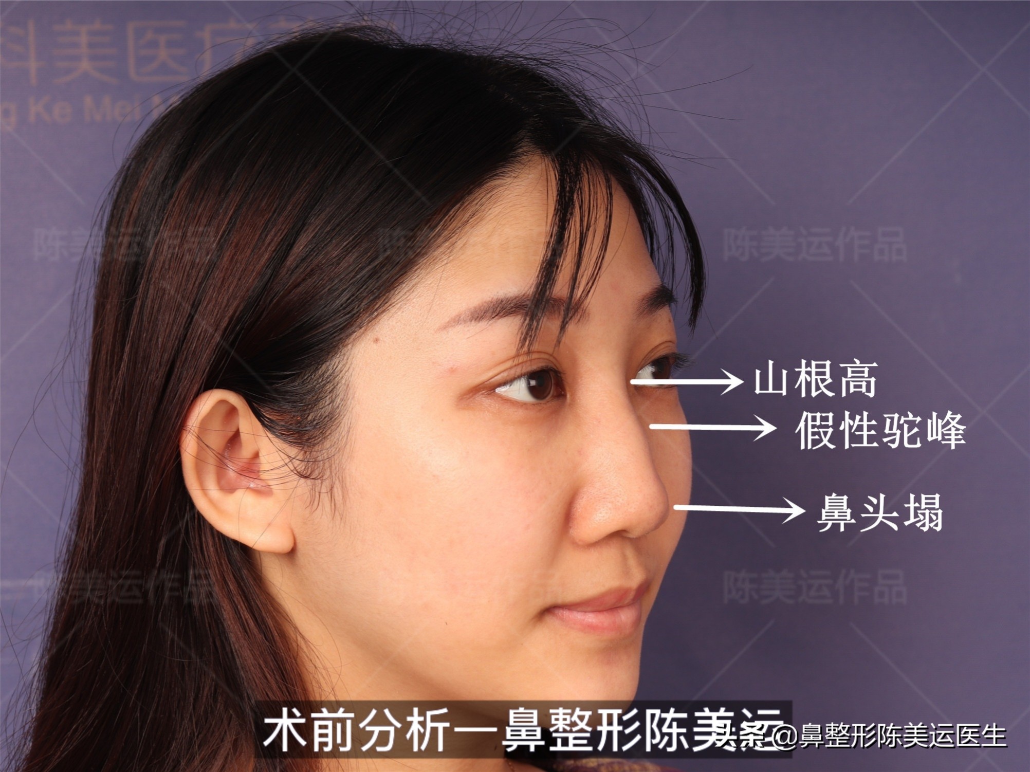 线雕隆鼻失败的图片,线雕隆鼻失败