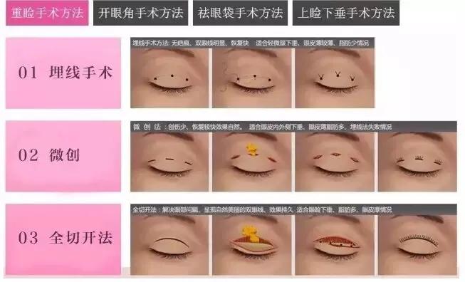 聊城创美整形双眼皮价格,聊城割双眼皮最好的正规医院