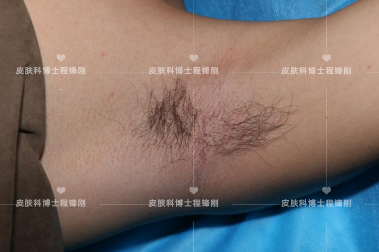 十七岁同学有遗传腋臭最好办法,男性有狐臭后代遗传的概率多大